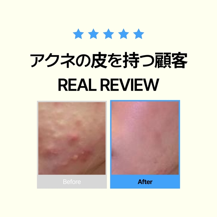 韓国で50万個販売!にきびケア!ニキビ皮脂調節洗顔フォーム+化粧水+クリームべた… | VICLE | 詳細画像2 