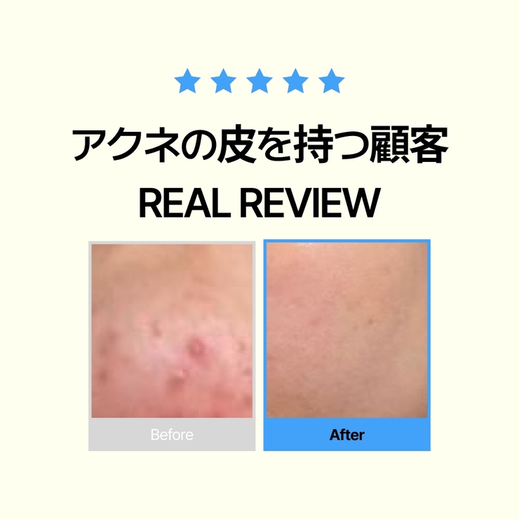 韓国で50万個販売!にきびケア!ニキビ皮脂調節洗顔フォーム+化粧水+クリームべた… | VICLE | 詳細画像3 