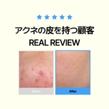 韓国で50万個販売!にきびケア!ニキビ皮脂調節洗顔フォーム+化粧水+クリームべた… | VICLE | 詳細画像3 